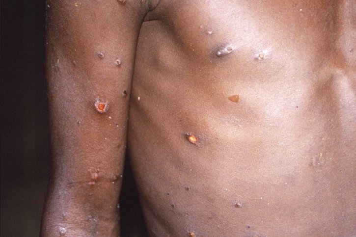 La variole du singe est endémique en Afrique de l'Ouest (archives). © KEYSTONE/AP
