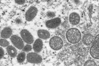 Premier cas de variole du singe en Italie