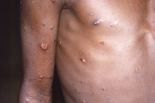 Premier cas suspect de variole du singe en Grèce