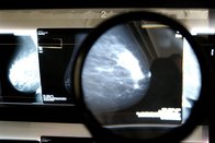 Les cancers du sein ou de la prostate toujours mieux cernés à Fribourg